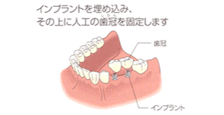 インプラントを埋め込み、その上に人口の歯冠を固定します