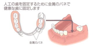 人口の歯を固定するために金属のバネで健康な歯に固定します