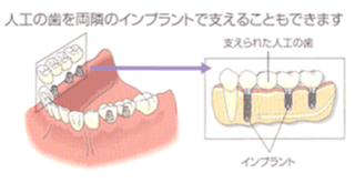 人口の歯を両隣のインプラントで支えることもできます