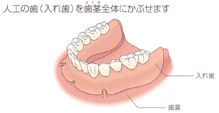 人口の歯(入れ歯)を歯茎全体にかぶせます