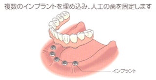 複数のインプラントを埋め込み、人口の歯を固定します